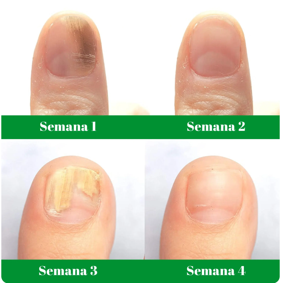 💧2X1 GOTAS DE TERBINAFINA PARA ELIMINAR 🍄HONGOS DE LAS UÑAS❌