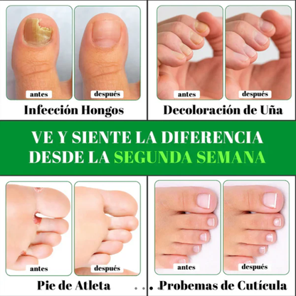 2X1 GOTAS DE TERBINAFINA PARA ELIMINAR HONGOS DE LAS UÑAS